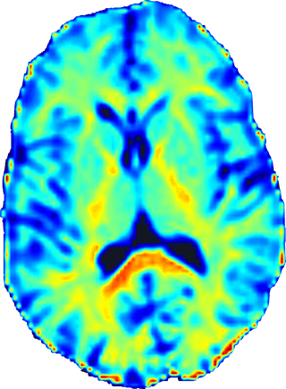 NDI - Neurite Density Index